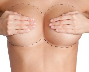 Here's When You Can Expect Your Breast Implants to Drop & Fluff - Cosmetic  Surgeons of Michigan, P.C.