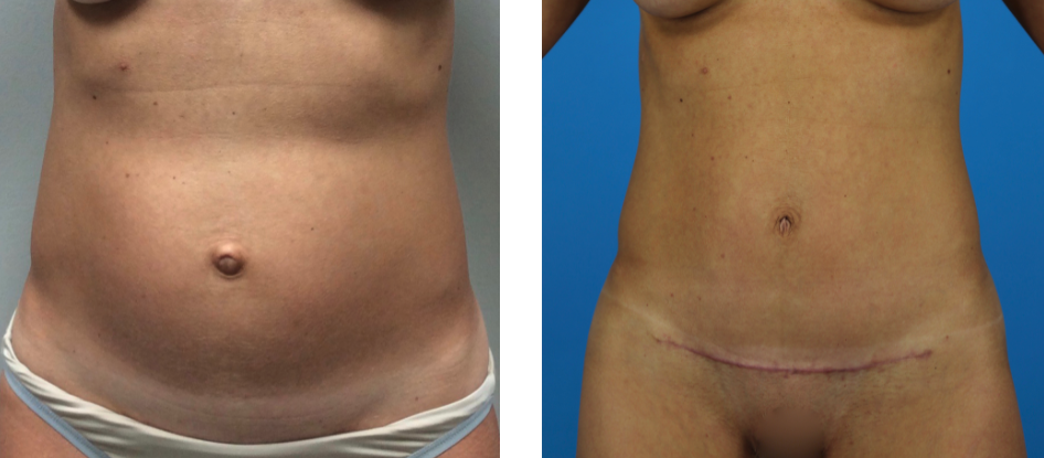 How Many Inches of my Waist Can I Lose With Tummy Tuck Surgery?