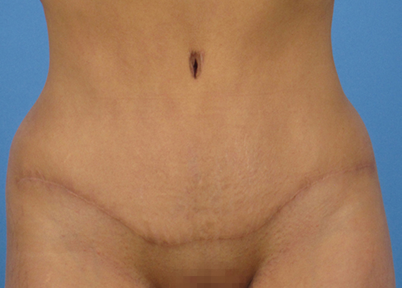 How Much Weight Can You Lose from a Tummy Tuck?